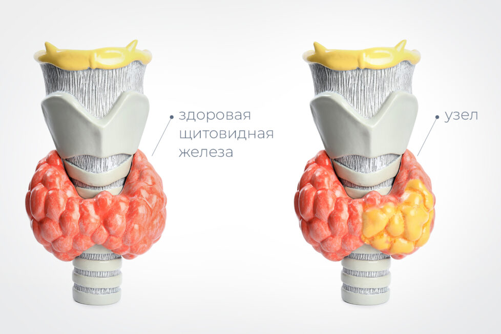 Узлы в щитовидной железе: размеры и норма, чем опасны