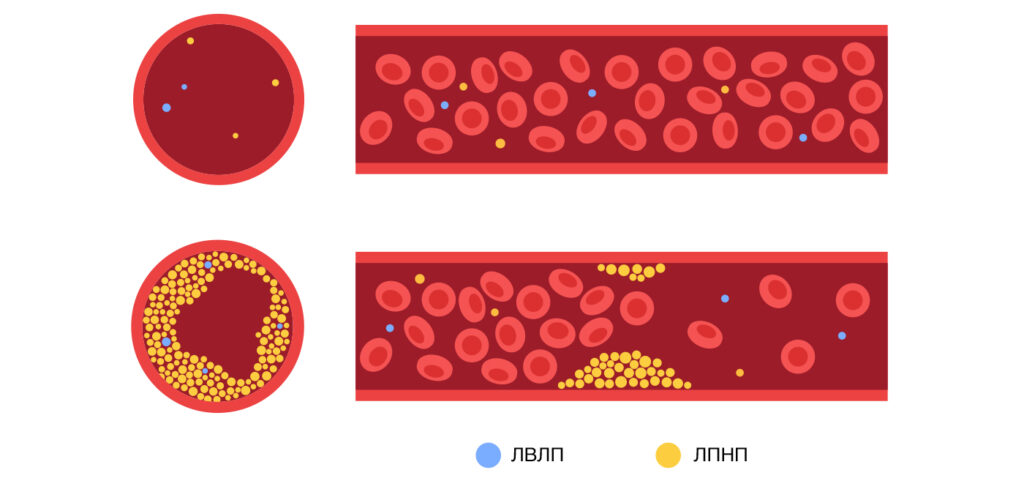 Холестерин – норма в крови у женщин и мужчин