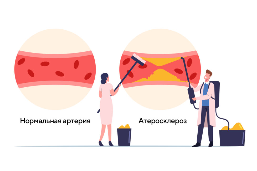 Холестерин ЛПВП (высокой плотности) понижен – что это значит